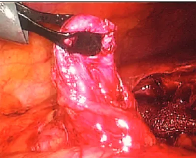FIGURA 1  – Dissecção do trajeto fistuloso entre o cólon  transverso e o fundo da vesícula biliar