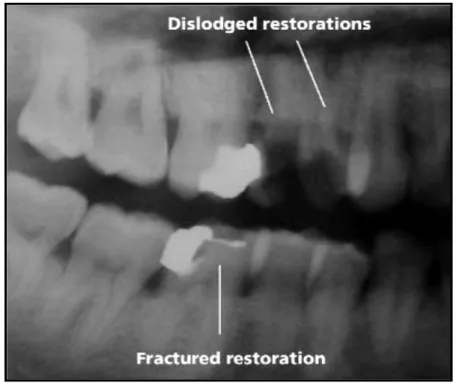 Figura 2  –  Radiografia panorâmica onde é possível observar a  fractura da restauração no molar inferior e até mesmo a perda  das  restaurações  nos  pré-molares  superiores  num  praticante  de mergulho