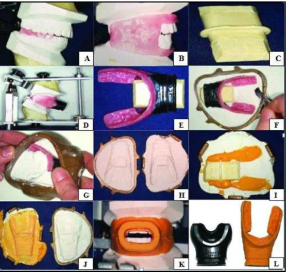 Figura 5  –   Procedimento  laboratorial  da  confeção  de um  bucal  individualizado