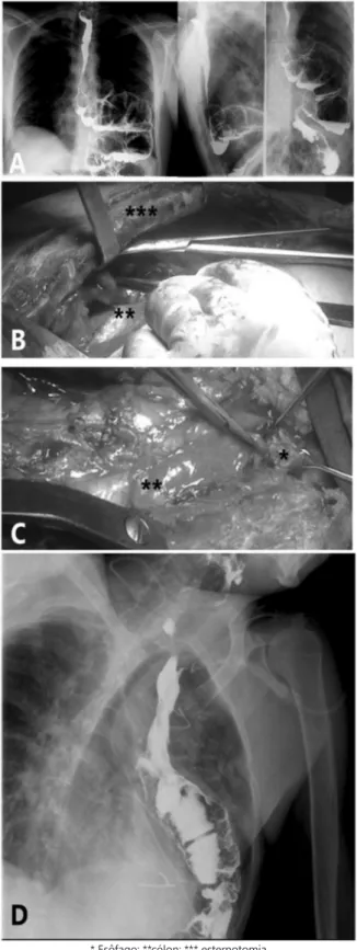 FIGURA 1  - Estenose intensa secundária à necrose de coto distal do 