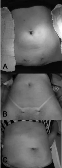 FIGURA 3  - Aspecto pós-operatório imediato: A) paciente  com parto cesáreo prévio; B) sem incisão prévia;  C) em 30 dias de pós-operatório