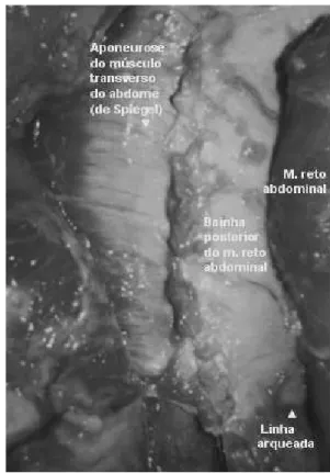 FIGURA 1 - Dissecção da aponeurose do músculo transverso  do abdome acima da linha arqueada em  cadáver não fixado com formalina