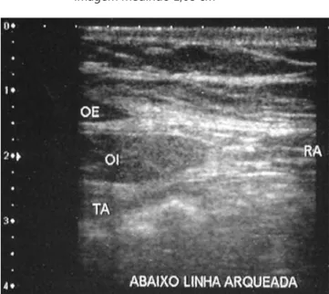 FIGURA 3 -   Imagem ultrassonográfica da parede abdominal  abaixo da linha arqueada. OE (oblíquo esterno),  OI (oblíquo interno), TA  (transverso) e RA (reto  abdominal) representam os músculos estudados