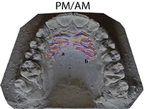 Figura  5.  Sobreposição  das  rugas  palatinas  através  de  dados antemortem  e  post-mortem:  a- 