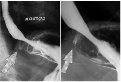 FIGURA 5 –  Radiografias contrastadas mostrando o adequado 