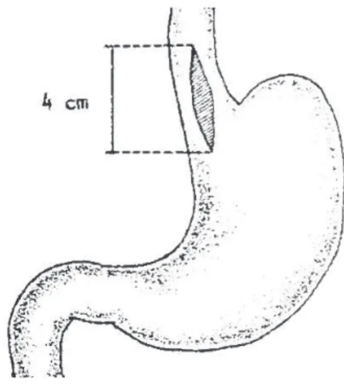 FigurA 1 – Miotomia da transição esofagogástrica