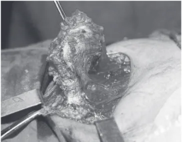 FigurA 2 - Exérese ampla do endometrioma e dos tecidos 
