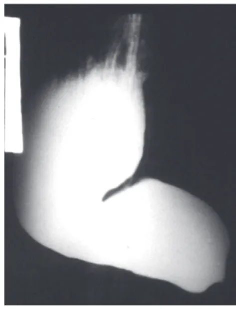 FigurA 1  –  Radiografia  contrastada  demonstrando 