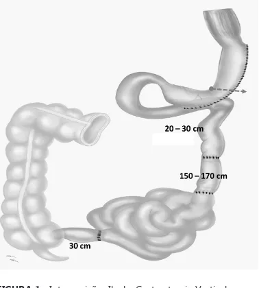 FIGURA 1 - Interposição  Ileal – Gastrectomia Vertical