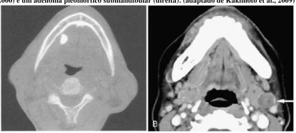Ilustração 11 - TC demonstrando um cálculo submandibular (esquerda) (adaptado de Freling,  2000) e um adenoma pleomórfico submandibular (direita)