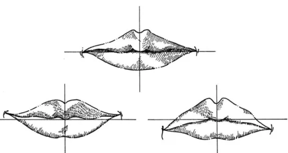 Figura 1 - Classificação das comissuras labiais (Fonte: Pueyo, 1994). 