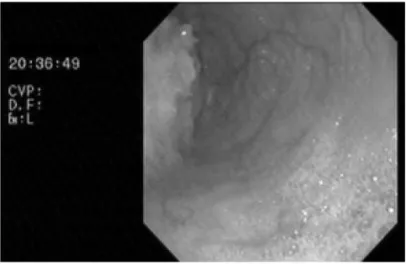 FIGURE 2 – Endoscopia digestiva alta demonstrando discreta 