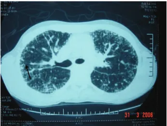 FIGURA  1  -  Extensas  e  difusas  dilatações  capilares  e  pré- pré-capilares nos campos pulmonares bilateralmente