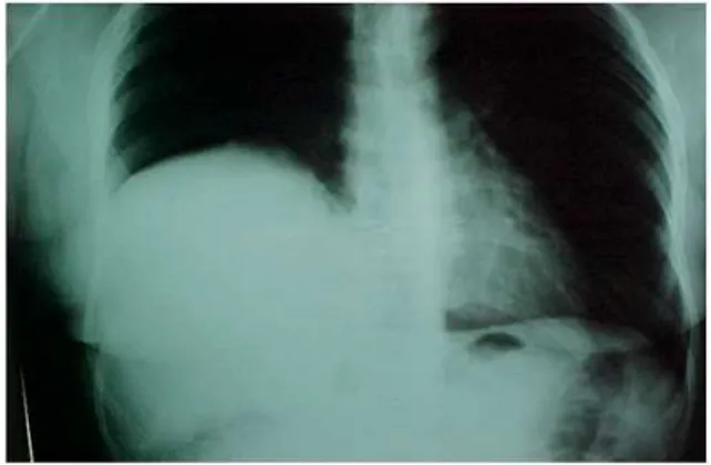 FIGURA 1 - Radiografia de tórax demonstrando elevação da hemicúpula diafrag- diafrag-mática direita