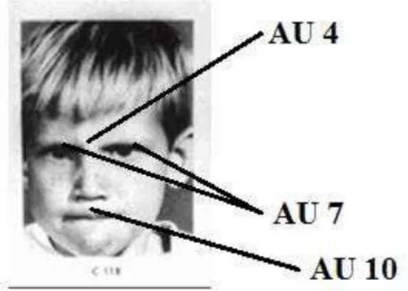 Figura  8.  Imagem  utilizada  por  Ekman  e  colaboradores  em  1966,  com  as  AU’s  associadas ao movimento fáciomuscular da cólera (Ekman, 1999b, p.304)