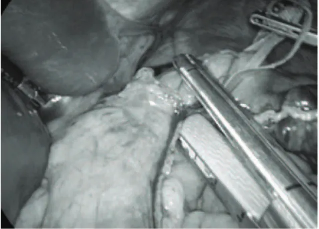 FIGURA 5 – Imagem laparoscópica da anastomose gastro-jeju- gastro-jeju-nal: bolsa gástrica (A), alça jejunal (B) e estômago  excluso (C)