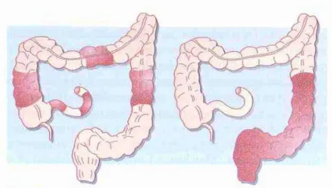 Figura 1 - Do lado esquerdo locais de lesão na DC e à direita locais de lesão na CU  (Adaptado de Beyer, 2012)