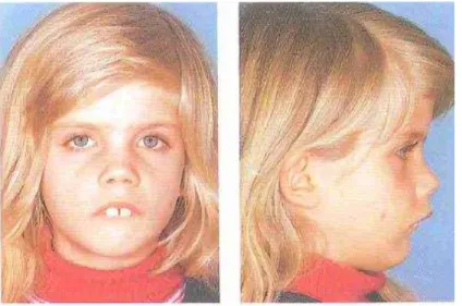 Figura 1. “ Face de Adenoide”. Vista frontal e de perfil de uma  paciente feminina de 6 anos de idade, com a função respiratória  nasal crônica restrita