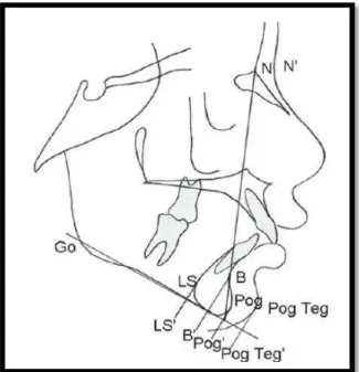 Figura  8.  Traçado  cefalométrico  do  pogônio  com  as  medidas  lineares. Adaptado de Retamoso, L