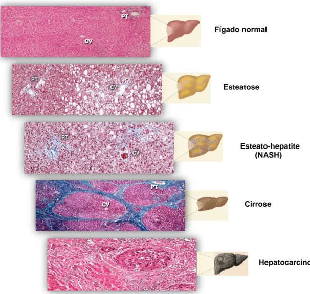 Figura 1. História natural de evolução da NAFLD  (adaptado de (7)).