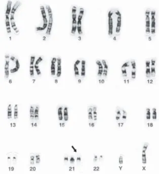 Figura 2 - Cariótipo de uma célula com 47 cromossomos, sendo três de número 21 (T21).  2