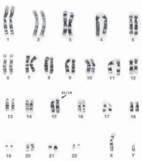 Figura 3 - Cariótipo Masculino de Trissomia do cromossoma 21 por Translocação do cromossoma 15 (21/15)