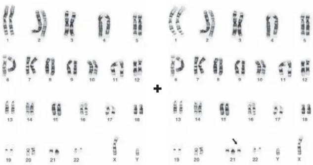 Figura 4 - Cariótipo de uma célula normal com 46 cromossomos e uma célula com 47 cromossomos, três 21