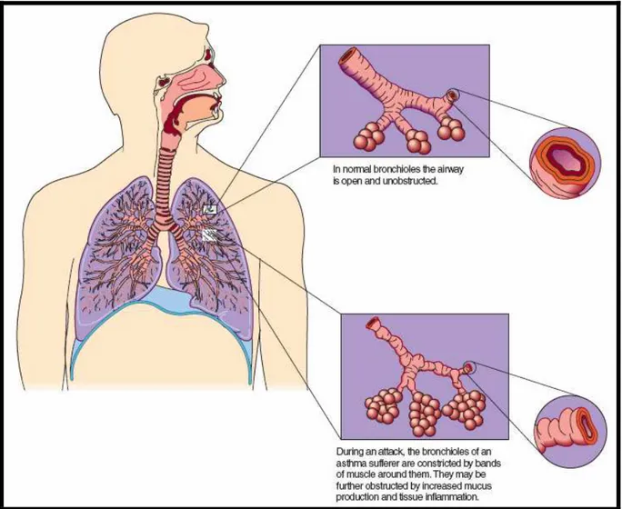 Ilustração 1 - Comparação entre bronquíolos normais e de um doente asmático. (Longe, 2001) 