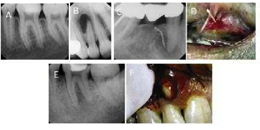 Figura 2 – Imagem ilustrativa de lesões periapicais. A- Periodontite apical sintomática  (aguda); B- Periodontite apical assintomática (crónica); C e D – Abcesso apical crónico; 