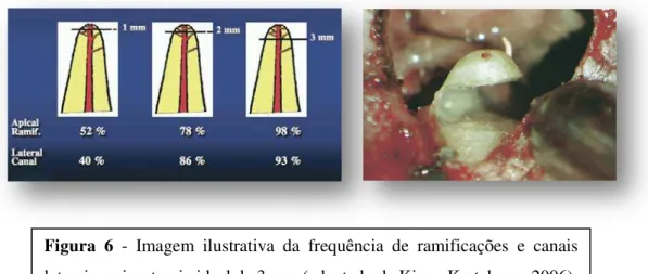 Figura  6  -  Imagem ilustrativa da frequência de ramificações e canais  laterais; apicectomia ideal de 3 mm (adaptado de Kim e Kratchman 2006)