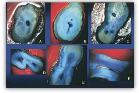 Figura 7 - Imagem ilustrativa de vários tipos de istmos (adaptado de Kim e  Kratchman 2006)