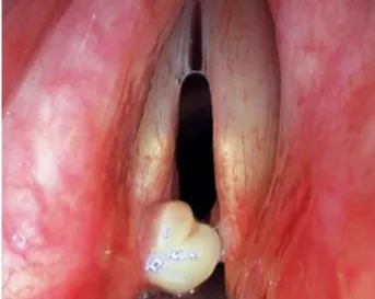 Figura 5: Granuloma com envolvimento  da corda vocal 18