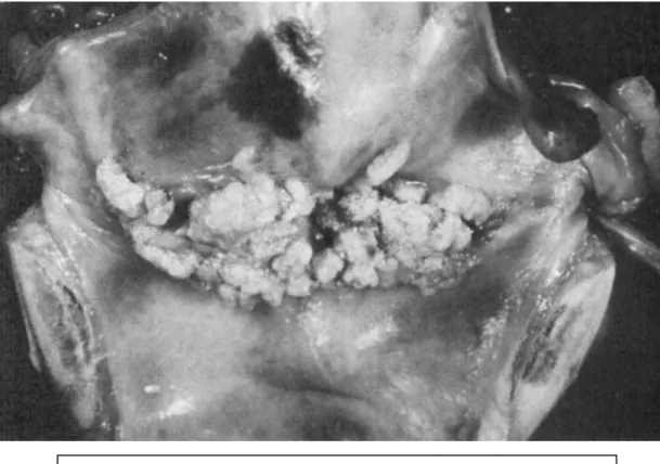 Figura 7: Carcinoma Verrucoso, atingindo ambas as cordas vocais 23 