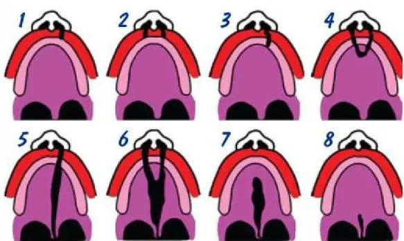 Figura 2- Tipos de Fendas Lábiopalatinas. 1- Fissura pré-foramen unilateral incompleta; 2-  Fissura pré-foramen bilateral incompleta; 3- Fissura pré-formamen unilateral completa; 4-  Fissura pré-foramen bilateral completa; 5- Fissura Transforamen unilatera