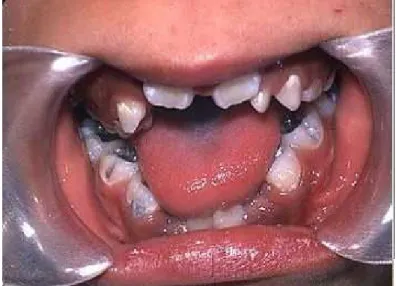 Figura 8 -Caracteristicas Dentárias da Disostose Mandibulo- Mandibulo-Facial