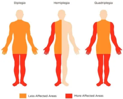 Figura  01:  Imagem  mostrando  as  partes  mais  afetadas  na  diplegia,  hemiplegia  e  tetraplegia  (quadriplegia)