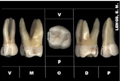 Figura nº1. - Anatomia externa do primeiro molar superior permanente. (Endo ‐ e, 2013)  (6).
