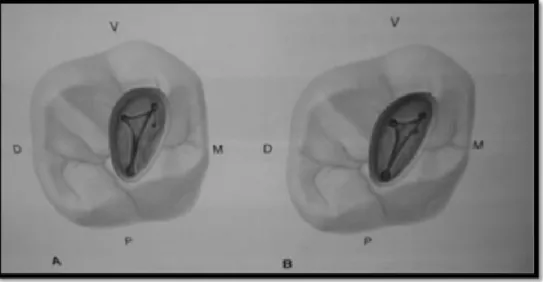 Figura  nº6.  –  Visualização  das  duas  entradas  do  canal  MV2  do  primeiro  molar  superior  permanente segundo o Vertucci e et