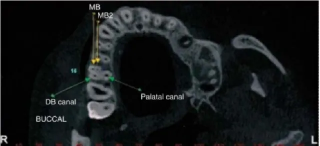 Figura nº10. – Tomografia CBCT corte axial. Imagem CBCT mostrando o canal MV1 e MV2  na raiz mesio-vestibular do primeiro molar superior (Adaptada de Abuabara et al., 2013)
