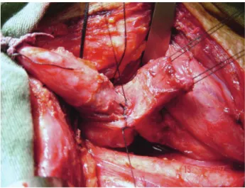 FIGURA 1 - Tubo gástrico transmediastinal para ser transposto  à região cervical