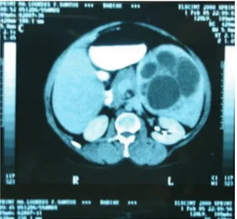 FIGURA 1 – Tomografia computadorizada de abdome mostrando 