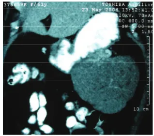 FIGURA 1 – Tomografia evidenciando massa abdominal em 