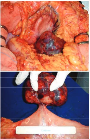 FIGURA 2 – Lesão na mucosa gástrica da pequena curvatura 
