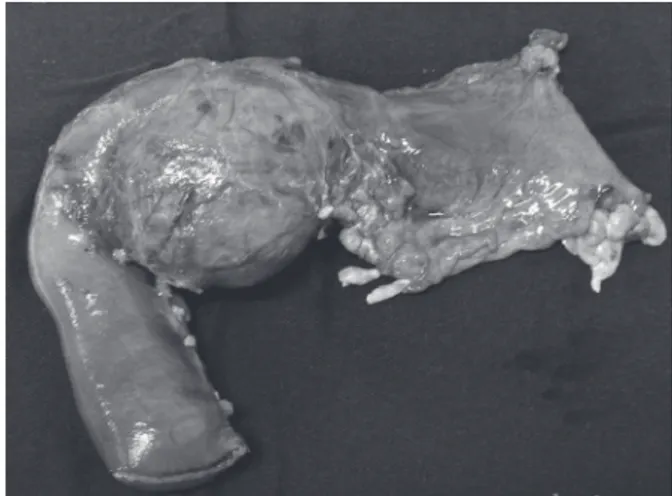 FIGURA 3 – Espécime cirúrgico mostrando também grande lesão 