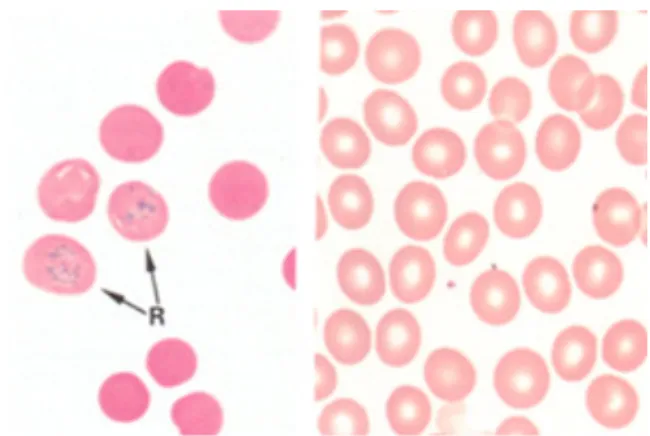 Figura 3. Estadios de diferenciação da linha eritróide no sangue periférico: reticulócitos (R) e  eritrócitos