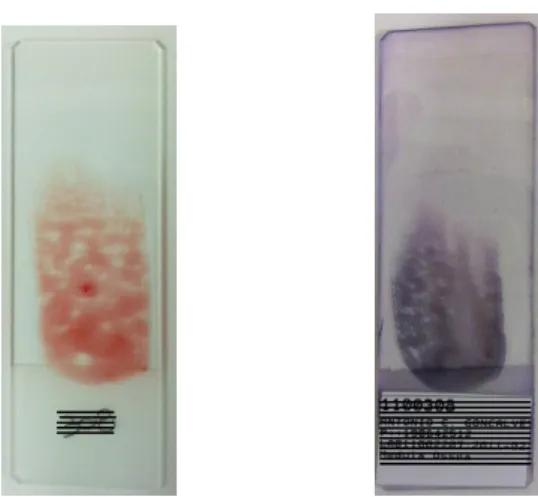 Figura 5. Esfregaços de medula óssea, sem e com coloração de Romanovsky. 