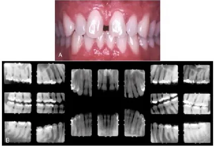Ilustração 4 – A, Imagem clínica de periodontite crónica leve (PCL). Caracteristicamente apresenta edema, eritema,  hemorragia  gengival  à  sondagem  e  supuração