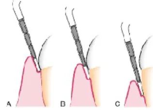 Ilustração 7 – Mesma profundidade de bolsa com diferentes graus de retração gengival.  A, Bolsa periodontal sem  retração  gengival