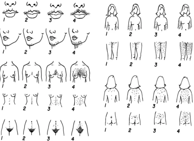 Figura 5. Sistema de pontuação do hirsutismo de Ferriman-Gallwey. A cada uma das nove áreas do  corpo  mais  sensíveis  aos  androgênios  é  atribuída  uma  pontuação  de  0  (sem  cabelo)  a  4  (francamente  viril),  de  acordo  com  a  quantidade  de  p