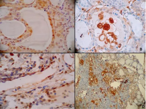 FIGURA 2 Imunomarcação com a galectina-3. (A) Adenoma Folicular [IRC + ; DRT  +]   aumento   de   100X